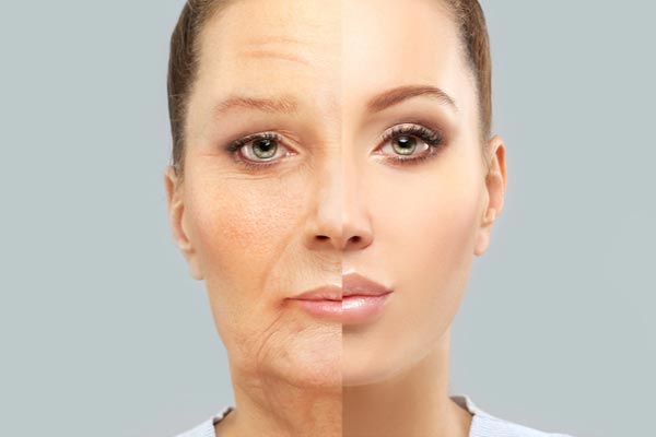 botox-anti-aging