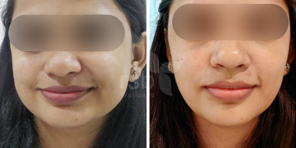 botox-treatement-mumbai-thane