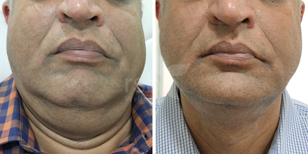 double-chin-treatement-mumbai-thane