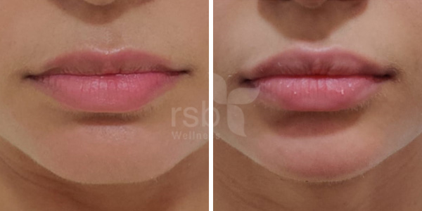 lip-filler-treatement-mumbai-thane