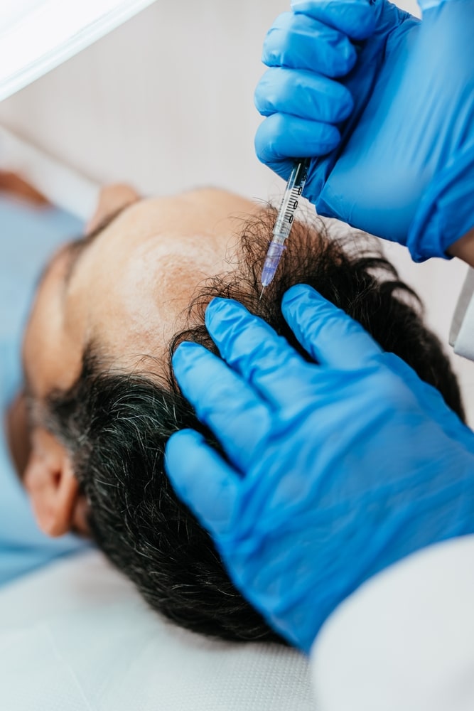 Advanced PRP Hair Treatment