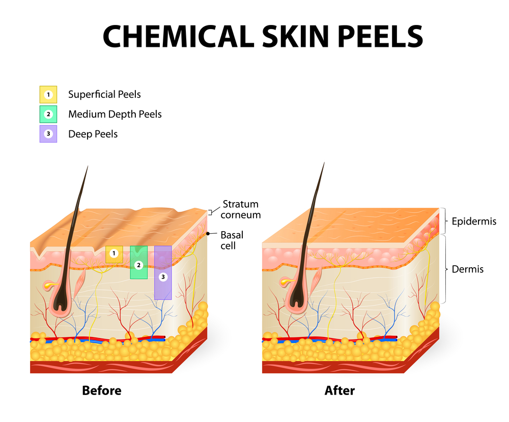 Chemical Peel